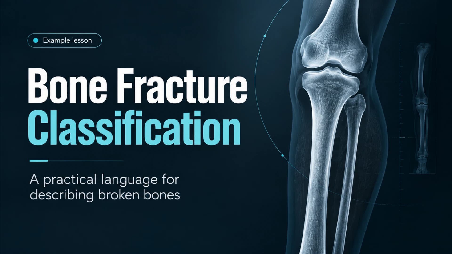 Dark navy cover with white and cyan bone fracture classification title beside a radiograph-style knee and lower-leg illustration